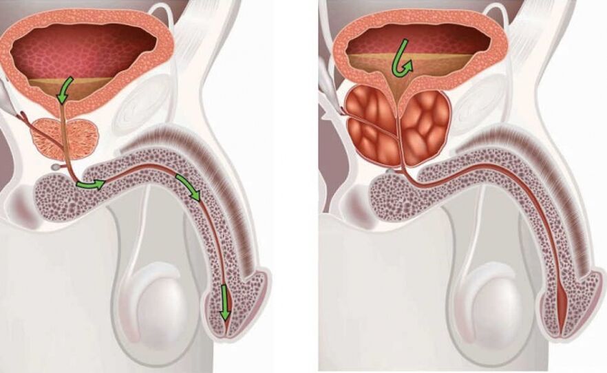 kaip prostatito gydymas veikia erekciją?