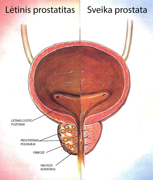 blogos erekcijos po prostatito gydymas priežastis kodėl nėra rytinės erekcijos